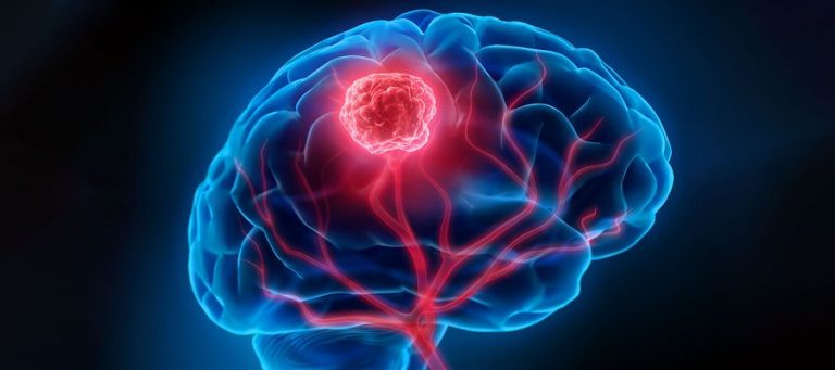 Anatomie Gehirntumor Abbildung