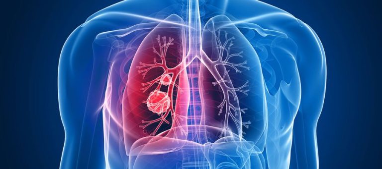 Anatomie Lungenkrebs Abbildung