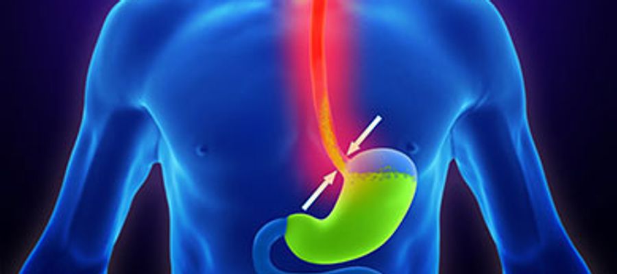 Anatomische Abbildung Reflux oder Sodbrennen am Ende der Speisröhre