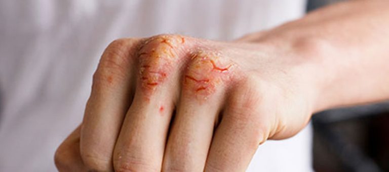 Hand mit rissiger Haut-an den Gelenken