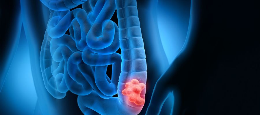 Anatomie Darmkrebs